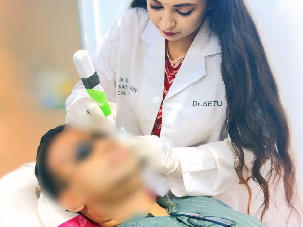 Acne scars — 6 sessions — before treatment